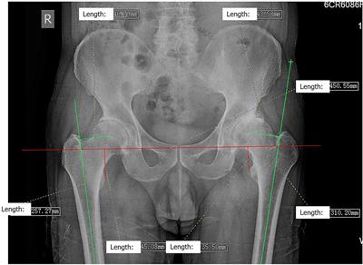 Accuracy of the Horizontal Calibrator in Correcting Leg Length and Restoring Femoral Offset in Total Hip Arthroplasty